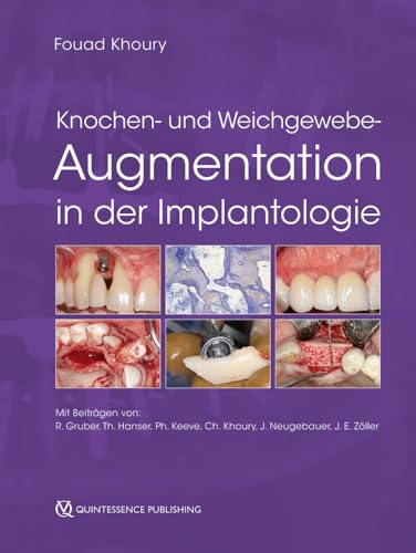 Knochen- und Weichgewebeaugmentation in der Implantologie