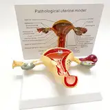 Pathologisches Modell der menschlichen Gebärmutter und des Eierstocks, Nachbildung der Anatomie des menschlichen Körpers des weiblichen Fortpflanzungssystems für Lehrmittel in der Arztpraxis