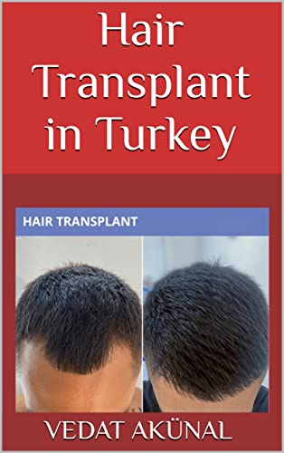 Hair Transplant in Turkey (English Edition)