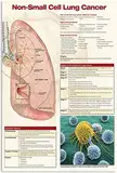 Metall-Blechschilder mit Wissen über Lungenkrebs, Vintage-Stil, Infografik-Poster zu nicht kleinzelligem Lungenkrebs, Leitlinien für Arztpraxen, Plaketten, Büro, Krankenhauszimmer, Heimwanddekoration,