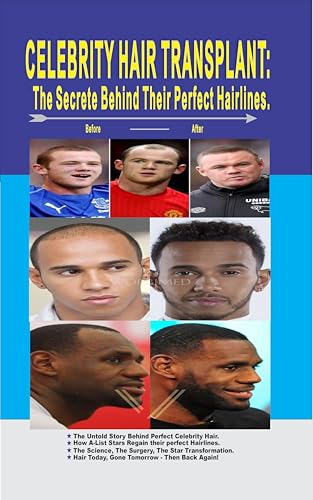 CELEBRITY HAIR TRANSPLANT, THE SECRETE BEHIND THEIR PERFECT HAIRLINES: Exposing the Secrets: The Truth About Celebrity Hair Regrowth (English Edition)