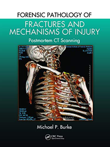 Forensic Pathology of Fractures and Mechanisms of Injury: Postmortem Ct Scanning